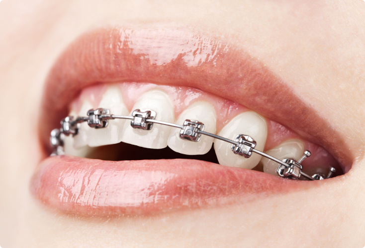 Self-Ligating Braces