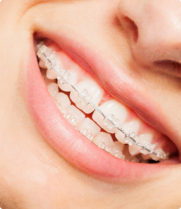 What Are Braces and How Do They Work